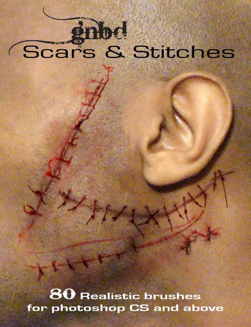 GNBD Scars & Stitches